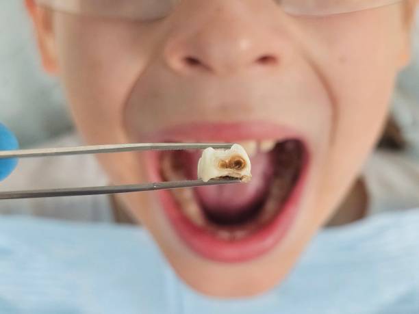 Best Broken or Cracked Tooth Emergency Dentist in Amity, OR